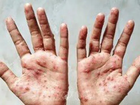 Khu vực phía Nam ghi nhận 199 ca đậu mùa khỉ, 8 ca tử vong trong 20 tháng qua