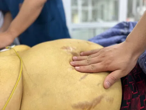 'Phá nát gan' vì sự chủ quan khi mắc viêm gan B